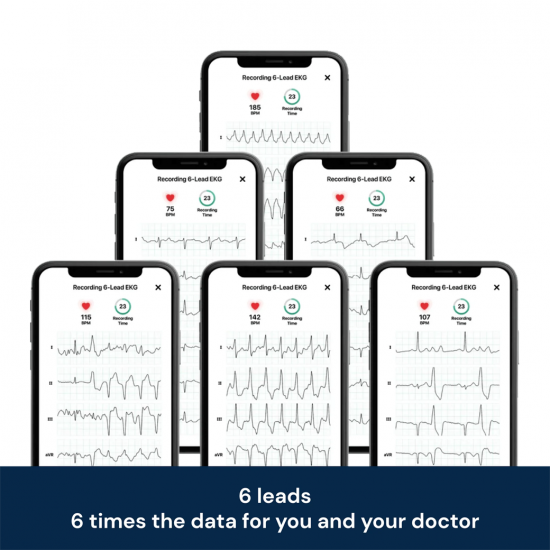 AliveCor KardiaMobile 6L เครื่องตรวจคลื่นไฟฟ้าหัวใจ (ชนิด 6 ลีด) แบบพกพา